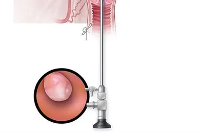 Endometrial Polip