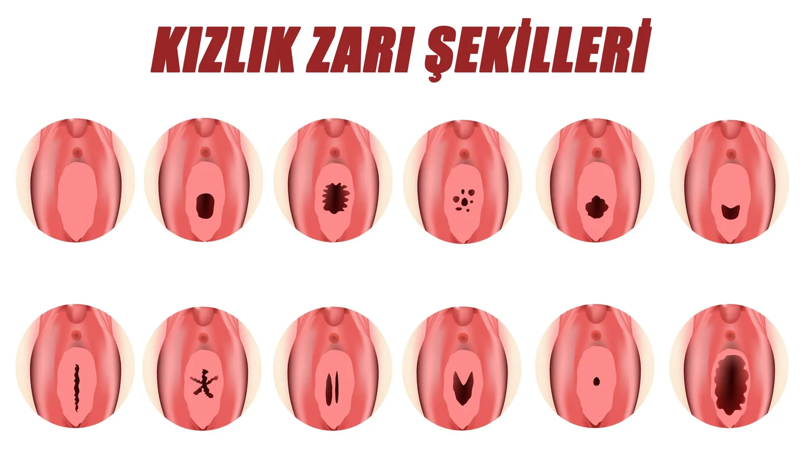 Kızlık zarı şekilleri: on iki farklı himen tipinin şematik çizimi