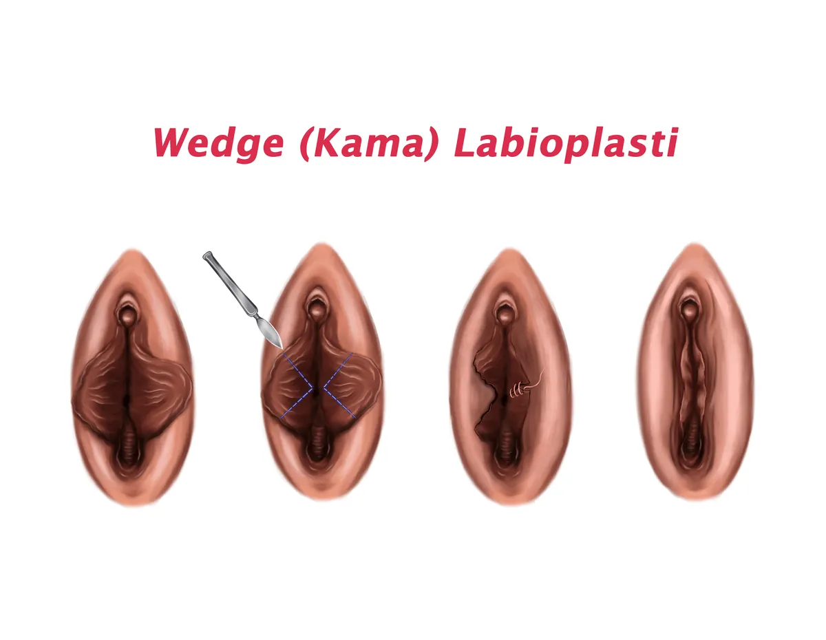 wedge labioplasti figür
