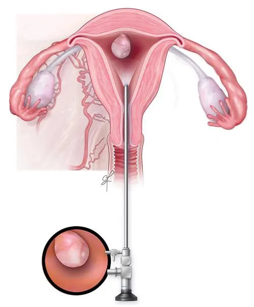 Endometrial Polip