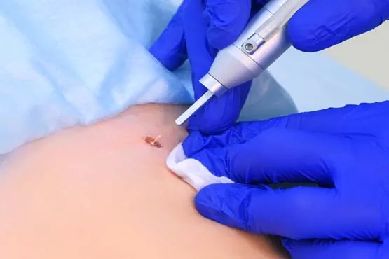 Traitement Des Verrues Par Laser