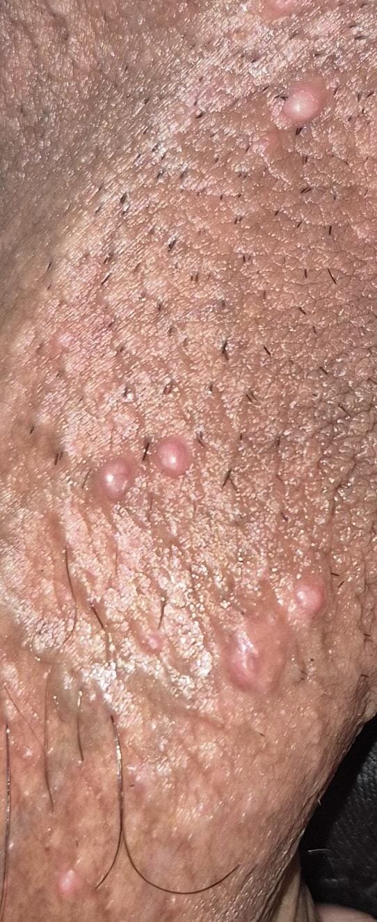 Molluscum contagiosum klinik görüntü 1 &mdash; Yüzeyi düzgün, inci gibi parlak, ortası hafif çökük (göbekli) molluscum kabartıları.