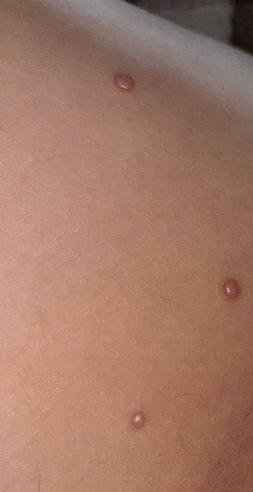 Molluscum contagiosum klinik görüntü 2 &mdash; Molluscum lezyonları siğil, uçuk ve akne ile karışabilir.