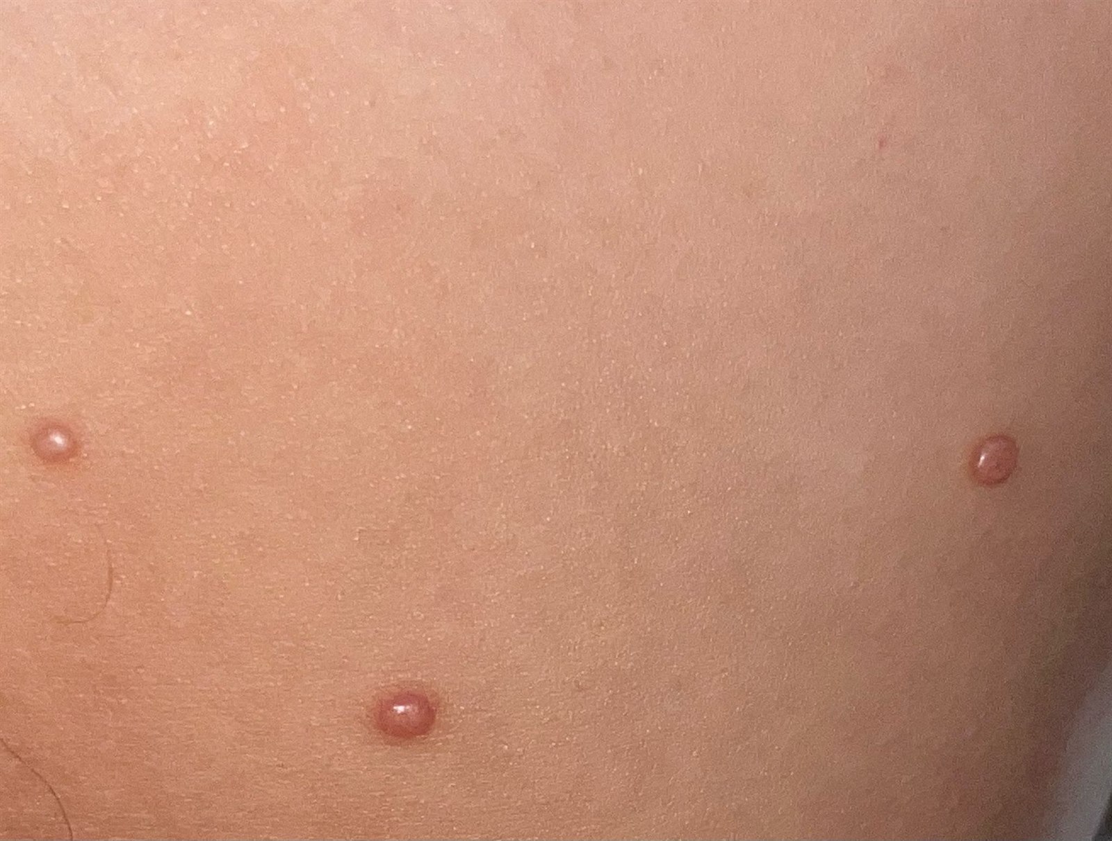 Molluscum contagiosum klinik görüntü 3 &mdash; Lezyonların içinde peynirimsi bir madde bulunur; sıkılması hâlinde çevreye yayılabilirler.