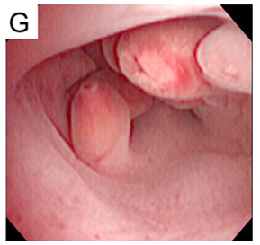 Endometrial Polip