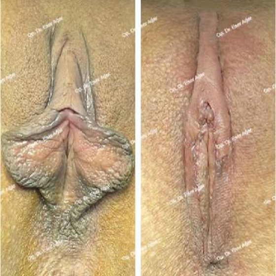RADIOFREQUENZ-LABIOPLASTIK