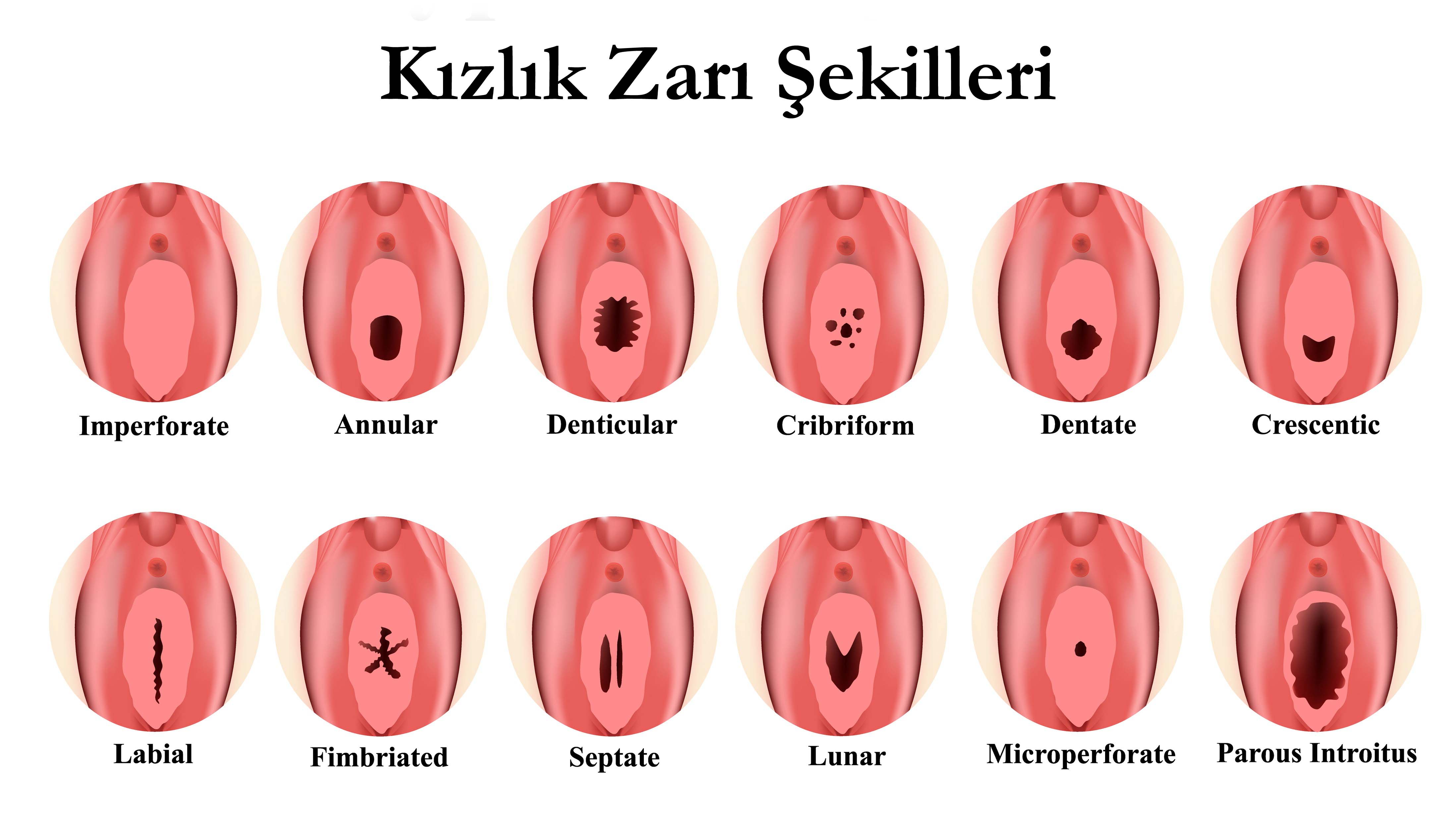 Kızlık Zarı Dikimi