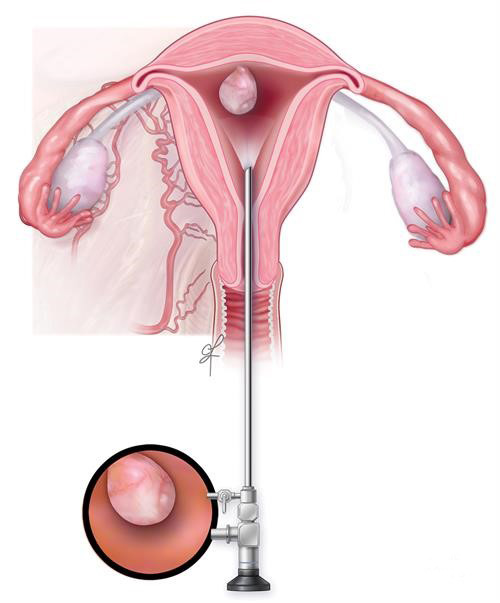 Endometrial Polip