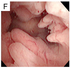 Endometrial Polip