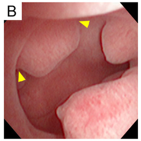 Endometrial Polip