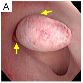Endometrial Polip