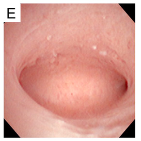 Endometrial Polip