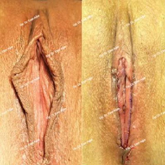 RADIOFREQUENZ-LABIOPLASTIK