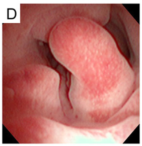 Endometrial Polip