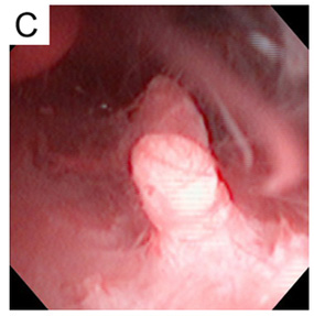 Endometrial Polip