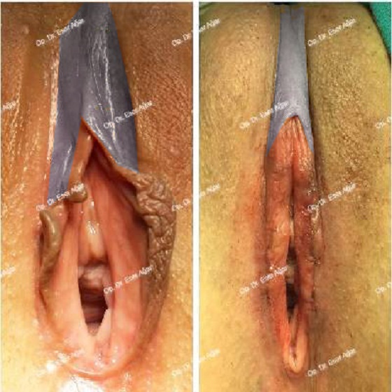 Ästhetik Der Klitoris